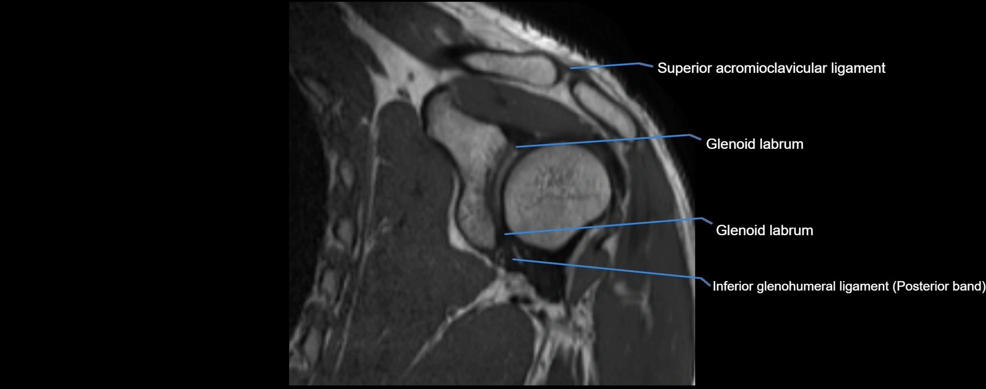 shoulder ligments coronal  cross sectional anatomy 3T MRI AI enhanced radiology image -img-00001-00028.webp